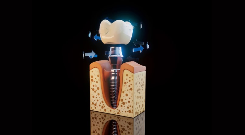 Dental Implant Planning: How Dentists Assess Bone and Oral Structures